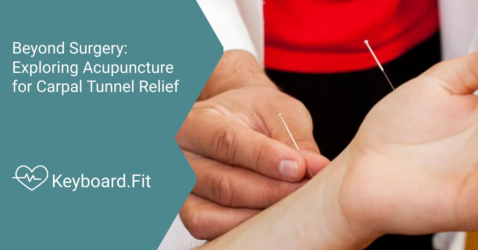Beyond Surgery Exploring Acupuncture for Carpal Tunnel Relief