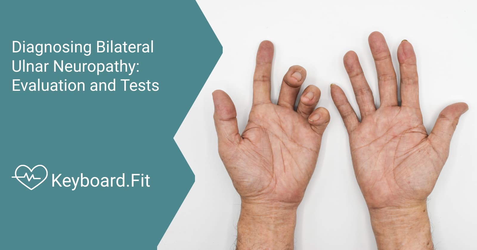 ulnar neuropathy bilateral icd 10